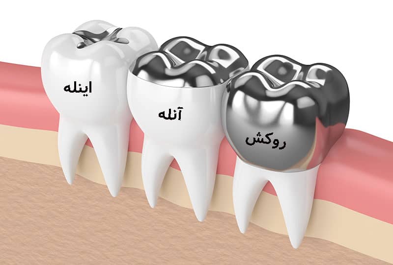 اینله و آنله دندان چیست و چه تفاوتی با روکش دندان دارد